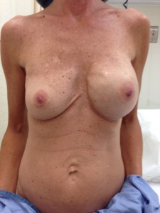 Congratulate, Deflated saline breast curious Deflated saline breast