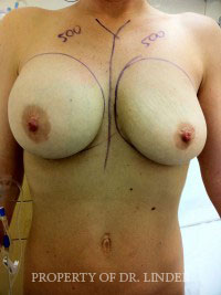 Rup-left-saline