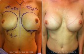 breast revision Case study of recent ruptured saline implant by Dr. Linder