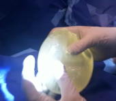 Screen Shot 2012-08-07 at 10.02.13 AM ruptured-implant-dr-linder