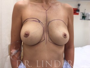 CUI breast implant