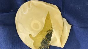 ruptured implant